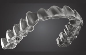 Ortodonzia trasparente dello Studio Dentistico Pasini Steffan Celant Rosso